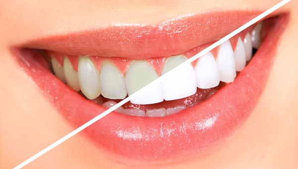 Kā mājas apstākļos ātri padarīt zobus baltākus?