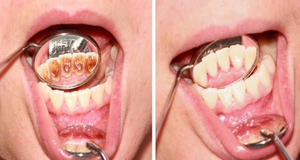 Kā atbrīvoties no zobu aplikuma un smaganu problēmām, neizmantojot dārgas ārstēšanas metodes